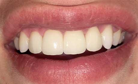 Smile-new-After