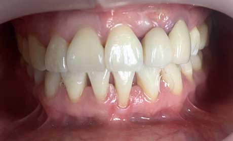 smile-jessica-before