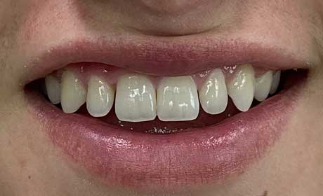 smile-new-before